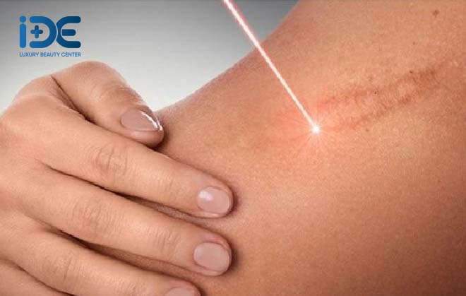 Laser trị sẹo