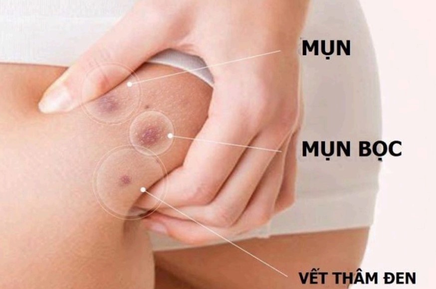 Thâm và mụn mông là gì?